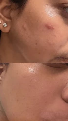 Azelaic Acid 10 Hyaluron Redness Soothing Serum